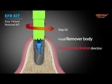 OSSTEM implant - EFR Kit (Easy Fixture Removal Kit)