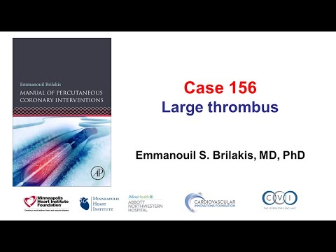 Case 156: Manual of PCI - Large thrombus