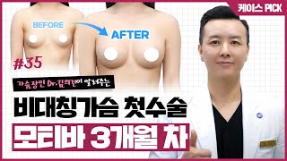 가슴 비대칭 (밑선과 볼륨 차이) 개선한 모티바 수술 3개월차!
