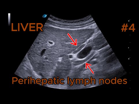 Perihepatic reactive lymph nodes video preview