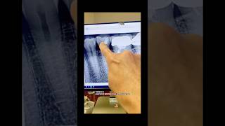 Three years post op. #dentists #apexdental #rootcanaltherapy #dentalartistry #dentalcare