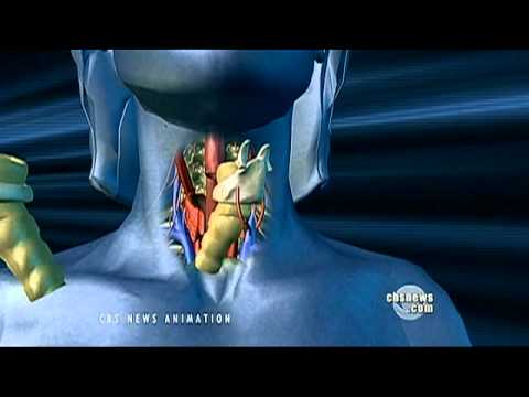 Woman Speaks First Words In 10 Years After Voice-Box Transplant