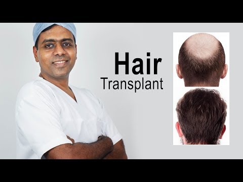 How A FUE Hair Transplant Surgery is Performed