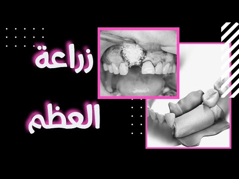 , title : 'أنواع زراعة العظم و التطعيم العظمي مع زراعة الأسنان'