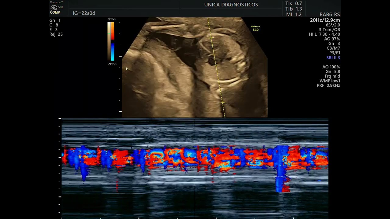 Ultrassom morfológico com ecocardiografia fetal