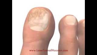 Houston House Call Podiatrist Explains Laser Toenail Fungus Treatment