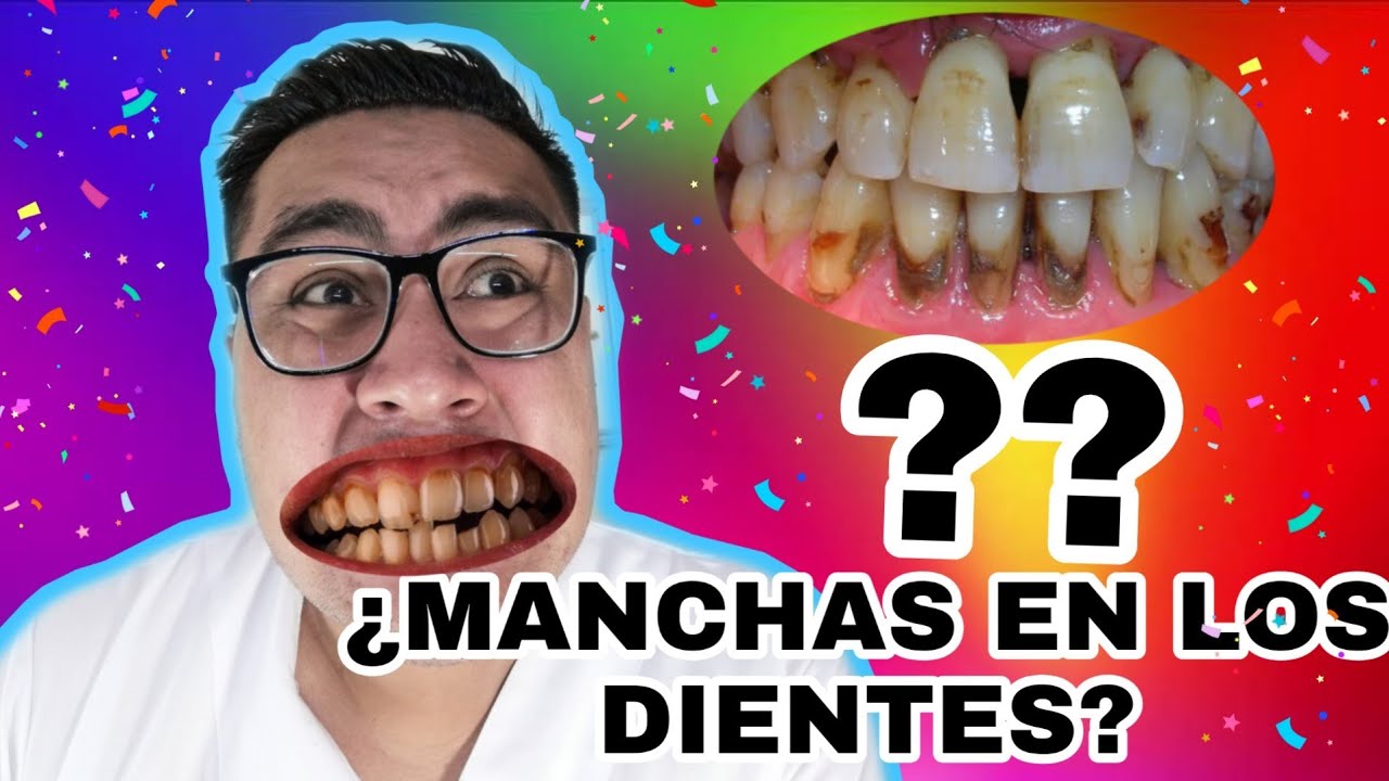 Watch MANCHAS EN LOS DIENTES - POR QUE SALEN Y COMO PUEDES ELIMINARLAS Now MANCHAS EN LOS DIENTES - POR QUE SALEN Y COMO PUEDES ELIMINARLAS