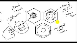 liver necrosis : DR SAMEH GHAZY