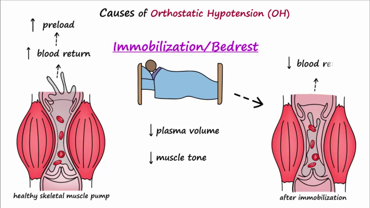 Orthostatic Hypotension (Described Concisely)