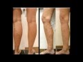 Get Rid Varicose Veins Naturally Review 