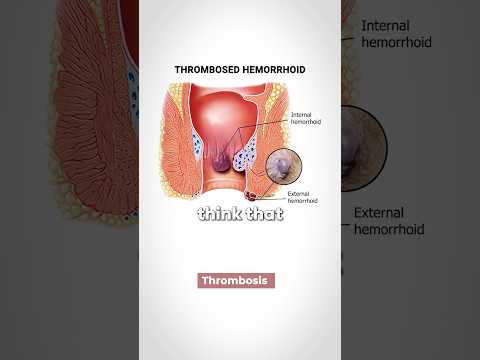 Hemorrhoids! What is the Cause?