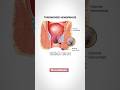 Hemorrhoids What Is The Cause
