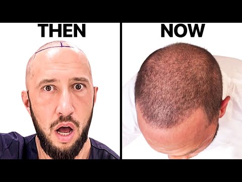 I Got A $2000 Hair Transplant In Turkey | Surgeon...