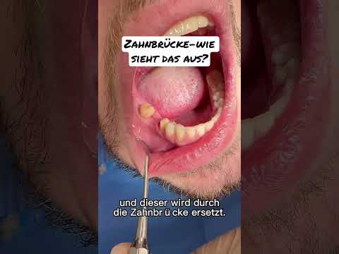 Zahnbrücke-Wie sieht’s im Mund aus? #zahnersatz #schönezähne #brücke #zahnlücke #zahnarzt