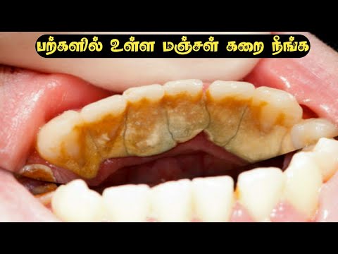 பற்களில் உள்ள மஞ்சள் கறை நீக்க எளிய வீட்டு வைத்தியம் Teeth Whitening tips in Tamil #shorts