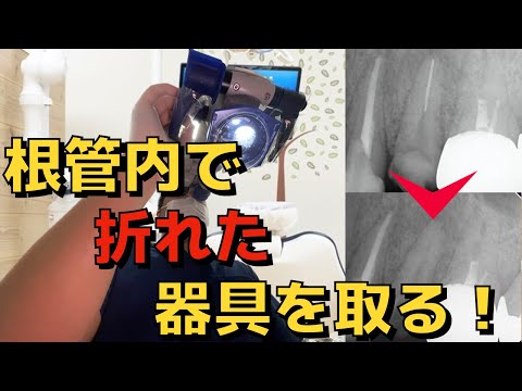 生命歯学科 マイクロスコープを用いた破折ファイルの除去！根管内で折れた器具（ファイル）の除去を詳しく解説します！