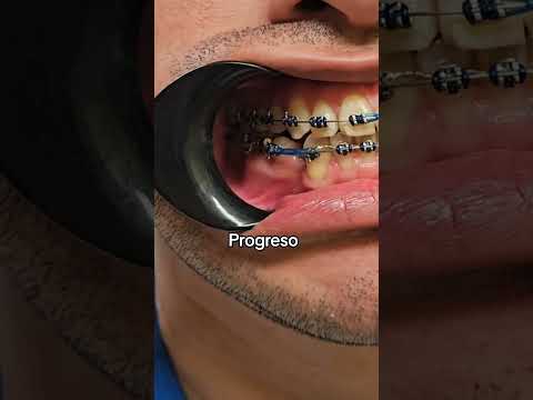 Nuevo progreso #brackets #ortodoncistas #tratamientodeortodoncia #ortodoncia