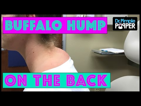 Il mal di schiena dopo lesercizio Hip magnete