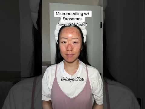 My results from Microneedling with Exosomes! First 7 days post treatment #shorts