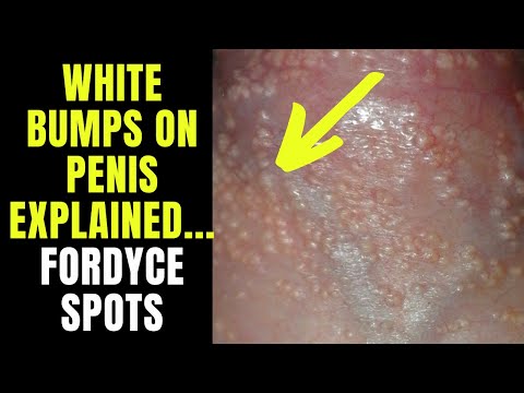 , title : 'Doctor explains FORDYCE SPOTS / GRANULES - small white spots or pimples on the penis...'