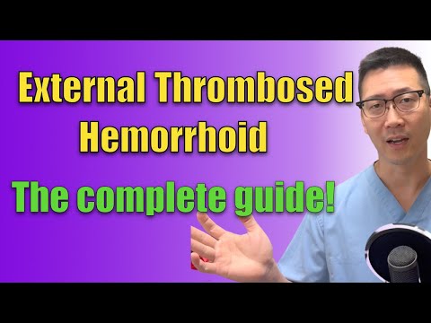External thromboses hemorrhoid: EVERYTHING you need to know!
