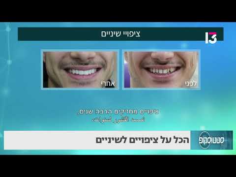 הכל על ציפויים לשיניים