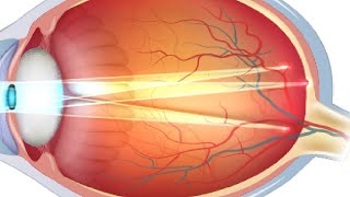 how to get rid of astigmatism in the eye naturally