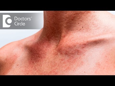 How to avoid and treat Summer Rashes and Stings? - Dr. Rajdeep Mysore