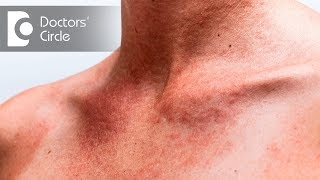 How to avoid and treat Summer Rashes and Stings? - Dr. Rajdeep Mysore