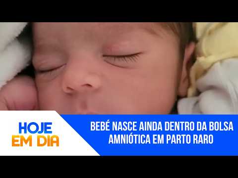 Bebé nasce ainda dentro da bolsa amniótica em parto raro em Mato Grosso