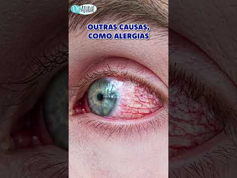 Eyes give SIGNS OF DISEASE