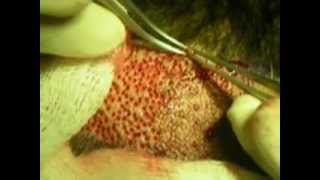 preview picture of video 'hair transplant pakistan islamabad price - FUE Procedure'