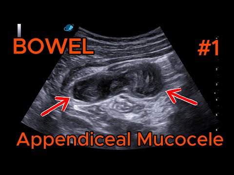 Appendiceal mucocele video preview