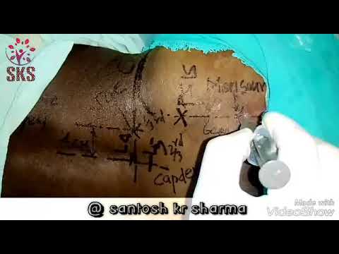Fondi da malattia degenerativa del disco del collo dellutero Cosa fare in osteocondrosi lombare