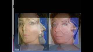 ד"ר אבישי וינברגר (מנתח פלסטי) - תמונות לפני ואחרי הרמת פנים/מתיחת פנים