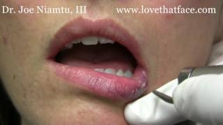 Venous Lake (hemangioma) Treatment with 940 Laser by Dr. Joe Niamtu