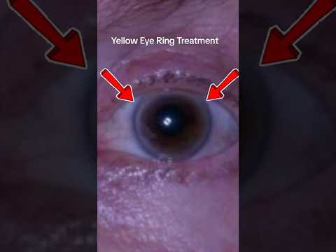 Finally, Yellow Eye Ring (Arcus)