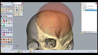 3D Printed Medical Implant Designing with Geomagic Freeform & Haptic Device | Graft3D Healthcare