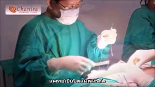 ถอดถุงซิลิโคนผ่านทางฐานหน้าอก
