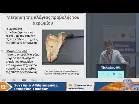 Tishukov Μ - H πλάγια προβολή του ακρωμίου από την ωμογληνη: συμβολή στη χρήση και την ερμηνεία του ακρωμιακού δείκτη και της κριτικής γωνιάς του ώμου