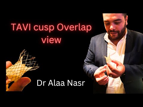 TAVI cusp overlap view ? Dr Alaa Nasr, 2023