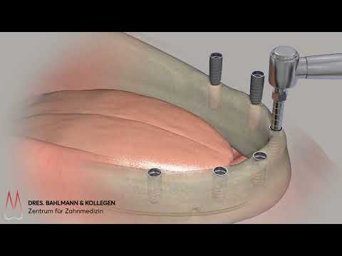 Feste Zähne an einem Tag Köln