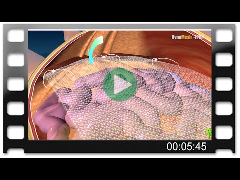 DynaMesh®-IPOM - Animation: Laparoscopic Repair of Incisional Hernia