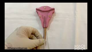 Copper T (Cu T) 380 A insertion and removal | IUCD Insertion| IUD| Interval copperT |OSCE| USMLE