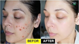 Remove the Spots from Your Face Naturally In Just 3 Nights!