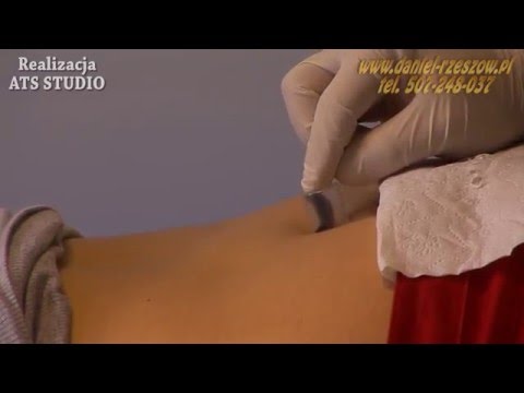 durere în caviar în varicoza varicoza pe picioarele tratamentului cu medicamente