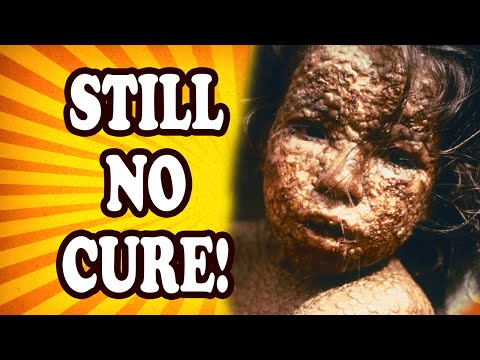 Top 10 Baffling Diseases We Still Don’t Have Cures For — TopTenzNet