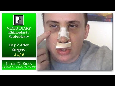 2. Male Rhinoplasty & Septoplasty Video Diary –Day 2 After Surgery, 2 of 6