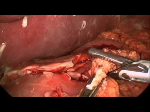 Laparoscopic Omental Patch for Perforated Peptic Ulcer - AVI