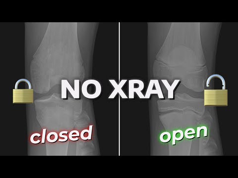 How To CHECK If Your Growth Plates Are Still OPEN! (Without X-ray)